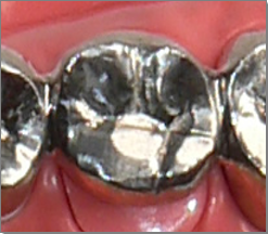 銀歯 ・金属アレルギーの不安 ・見た目の悪さ ・歯肉への悪影響