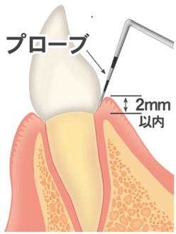 健康な歯肉 歯周ポケットが３ミリ以内です。