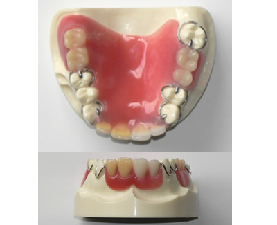 プラスチック 義歯