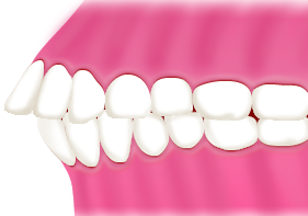 出っ歯(上顎が下顎よりも大きい) 八重歯（歯が生える場所がない為、でこぼこに生えている) 