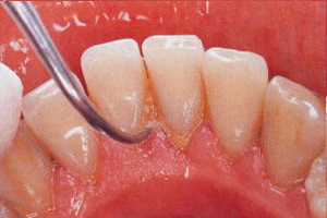 超音波スケーラによる歯石の除去
