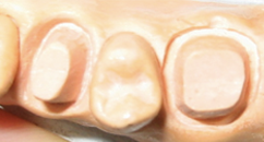 歯型の石膏模型