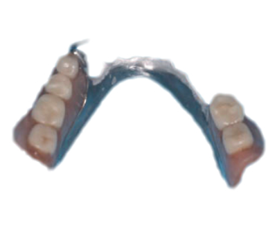 コバルト クロム床 義歯
