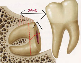 歯冠をとるとスペースができるためそこから歯根を取り出します
